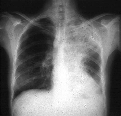 Blastomycosis in humans causes, symptoms, diagnosis and treatment