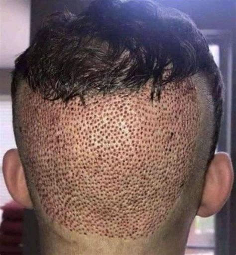 trypophobia hair transplant holes - See Goodie Journal Photo Galery