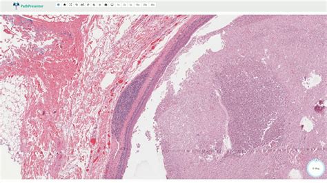 Branchial Cyst Histology