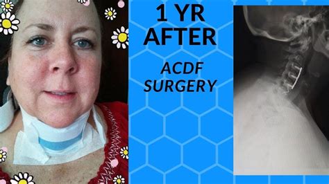 1 YR POST ACDF SURGERY UPDATE! 3 level C-3 C7 Cervical Fusion Surgery | Acdf surgery, Neck ...