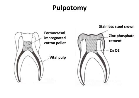 What is pulpotomy? | News | Dentagama