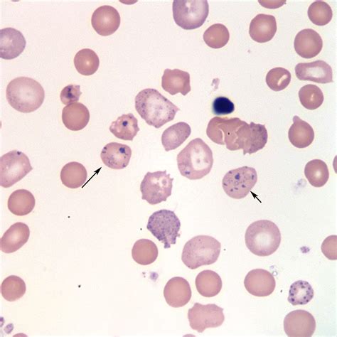 siderocyte Archives | eClinpath