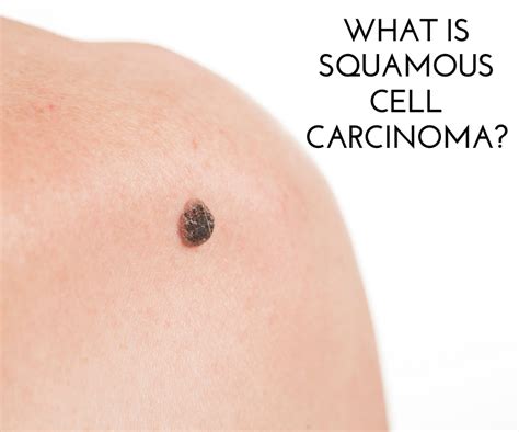 What is Squamous Cell Carcinoma? | Oakland Hills Dermatology