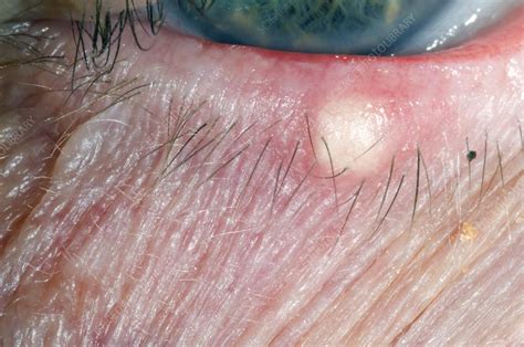 Chalazion cyst on the lower eyelid - Stock Image - C006/9188 - Science Photo Library