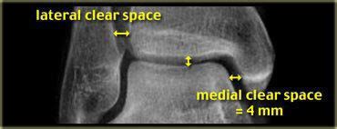 The Radiology Assistant : Fracture mechanism and Radiography