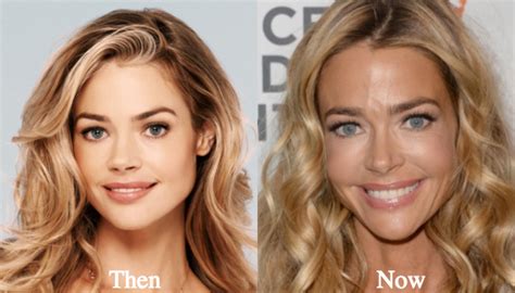 Denise Richards Plastic Surgery Before and After Photos