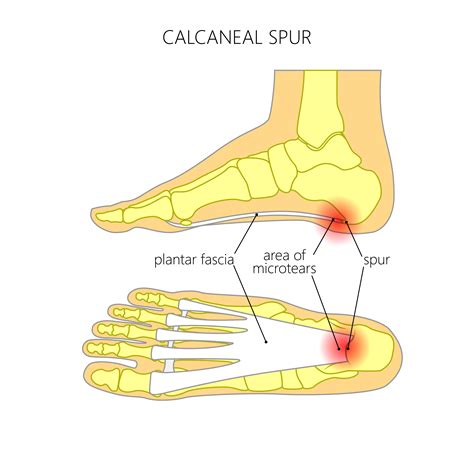 Heel Pain: Plantar Fasciitis & Heel Spurs | Bakewell Osteopathy Clinic