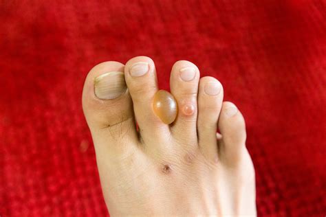 Diabetes and feet – Diabetic Blisters Diagnosis