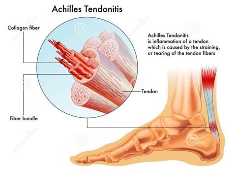 How to bill PRP Injections for Achilles Tendonitis - Podiatry Coding