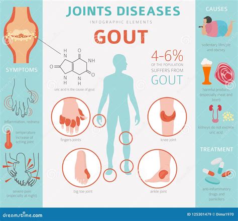 Joints Diseases. Gout Symptoms, Treatment Icon Set Stock Vector - Illustration of infographic ...