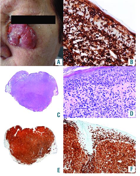 ALK-negative primary cutaneous anaplastic large cell lymphoma with ...