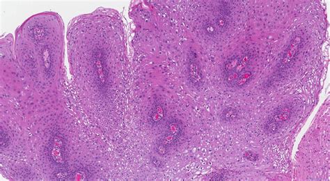 Squamous papilloma of the oral cavity | Ottawa Atlas of Pathology