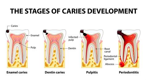 Dentosphere : World of Dentistry: How Long Do Dental Restorations Last?