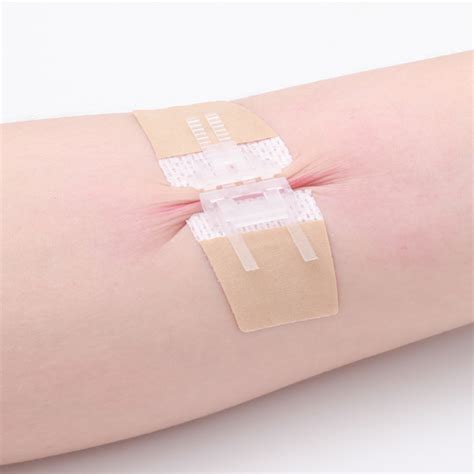 Wound Closure Device--Longmed Medical Technology Company