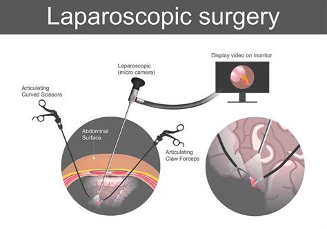 Laparoscopic Hernia Surgery in Katy, TX | Dr. Clay Albrecht