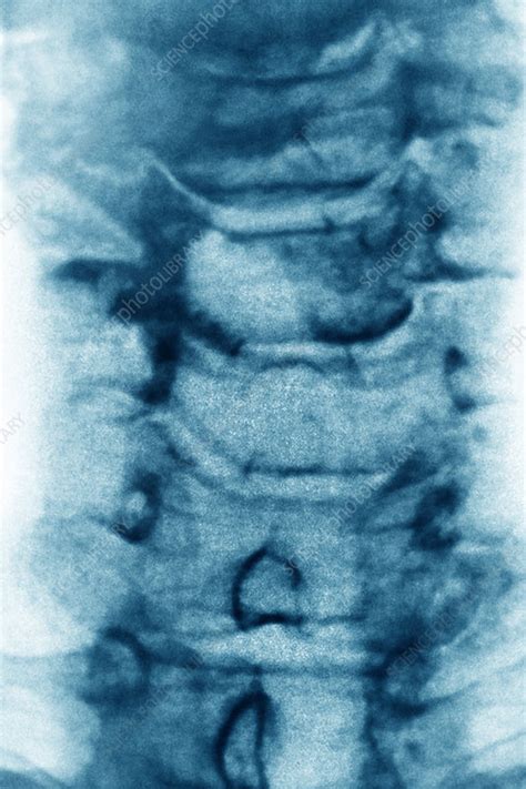 Cervical spondylosis, X-ray - Stock Image - C030/6249 - Science Photo Library