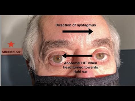 What ear does the nystagmus in vestibular neuritis beat towards? - YouTube