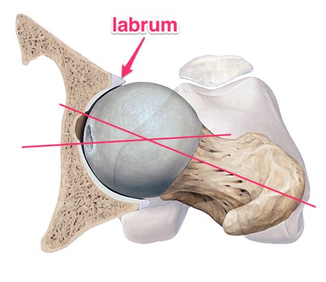 Is Yoga Tearing Labrums? - Yoga Anatomy