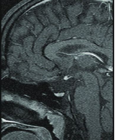 Magnetic resonance imaging-T1W brain sagittal image demonstrating... | Download Scientific Diagram