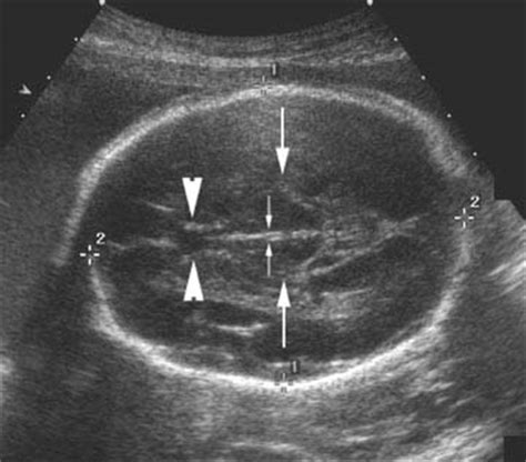 Second and Third Trimester Fetal Anatomy | Radiology Key