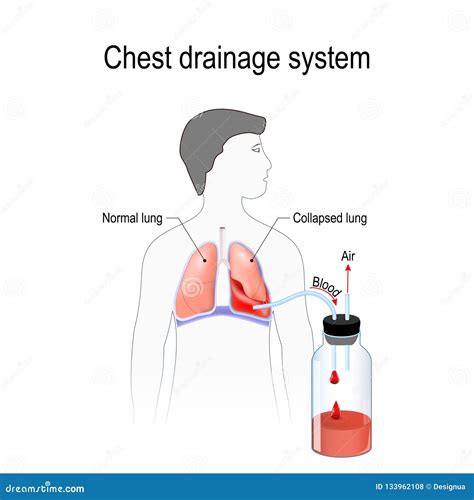 Hemothorax. Chest Drainage System Stock Vector - Illustration of aspiration, canister: 133962108