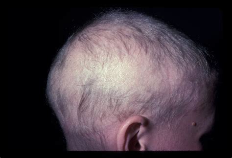 Totalis Alopecia - StatPearls - NCBI Bookshelf