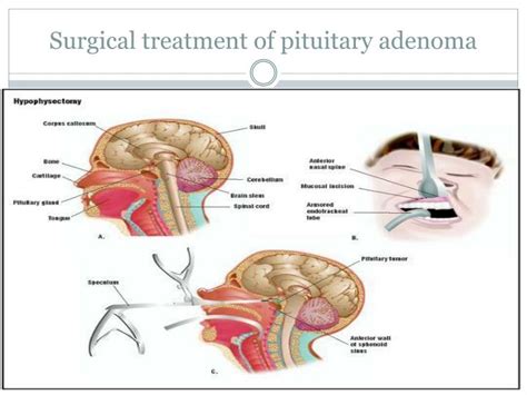 PPT - Pituitary tumors PowerPoint Presentation - ID:1954831