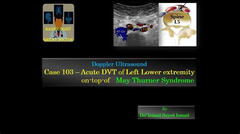 Ultrasound Case 103 - Acute DVT on-top-of May Thurner Syndrome - YouTube