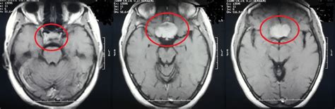 sphenoidal meningioma