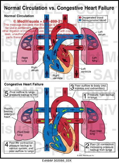 Normal circulation vs congestive heart failure medical exhibit – Artofit