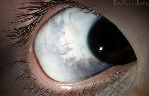 Atlas Entry - Oculodermal melanocytosis (nevus of Ota)