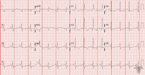 Right Heart Strain | ECG Stampede