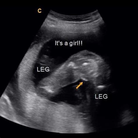 Baby Gender Ultrasound Near Me - Get More Anythink's