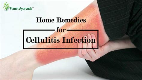 Home Remedies for Cellulitis Infection