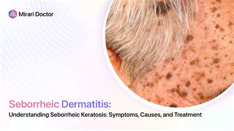 Understanding Seborrheic Keratosis: Symptoms, Causes, and Treatment