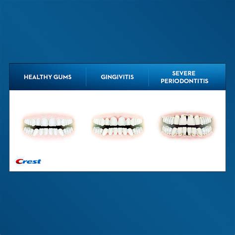 Gum Disease Pictures: What do Healthy Gums Look Like?