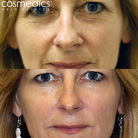 Dermal Filler Injections London & Bristol | Cosmedics Skin Clinics