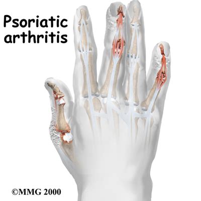 Psoriatic Arthritis (Psoriatic Arthropathy) Treatment, Symptoms & Causes