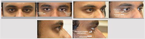 What is Eye Shape Change? Dr. Taban MD | Beverly Hills, Ca