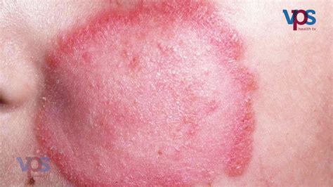 Fungal Skin Conditions