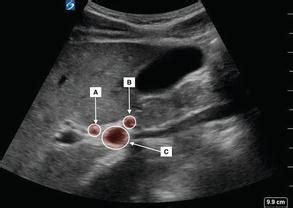 Biliary Ultrasound | Radiology Key