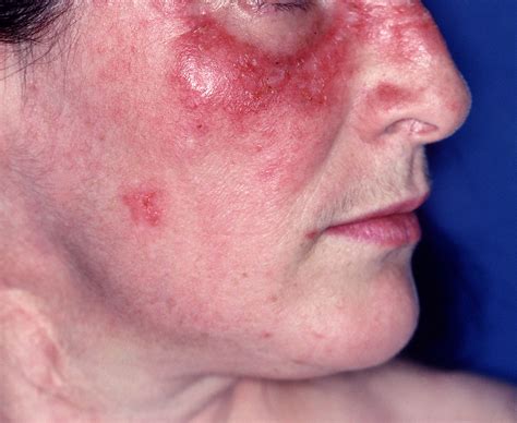 B-Cell Depletion Therapy With Rituximab Effective for Cutaneous Lupus Erythematosus ...