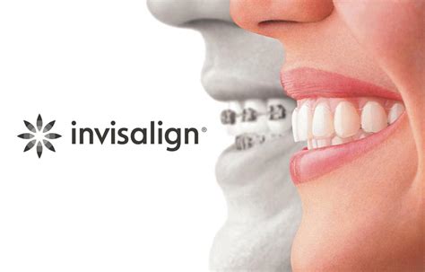 Invisalign Clear Aligners | Rock Hill