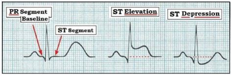 ECG Interpretation: ECG Interpretation Review #12 (Computerized ECG Interpretation, Normal ...