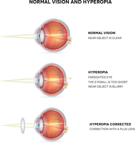 4 Types of Refractive Errors (Plus Treatment Options)