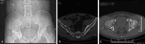 A, Oval on X-ray showed lesions in the right ilium and ischium. B, The... | Download Scientific ...