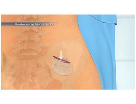 Sacral Nerve Stimulation (SNS) - Paul E. Savoca