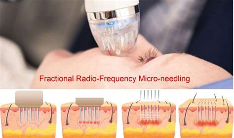 Fractional Radio-Frequency Micro-Needling Skin Rejuvenation - Laser ...