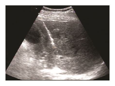 Ultrasound-guided liver biopsy and grade of immunohistochemical ...