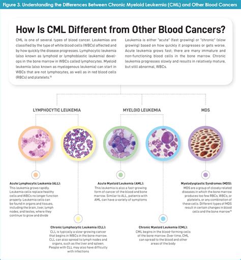 Leukemia Types And Prognosis